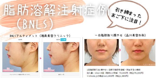 脂肪溶解注射とハイフどっちがいいか比較