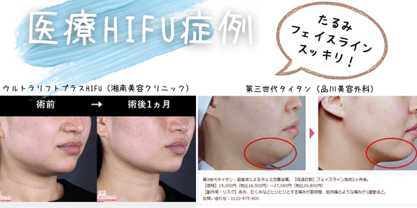 脂肪溶解注射とハイフどっちがいいか比較